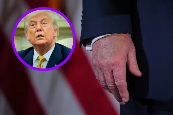 Donald Trump recibe diagnóstico de insuficiencia venosa